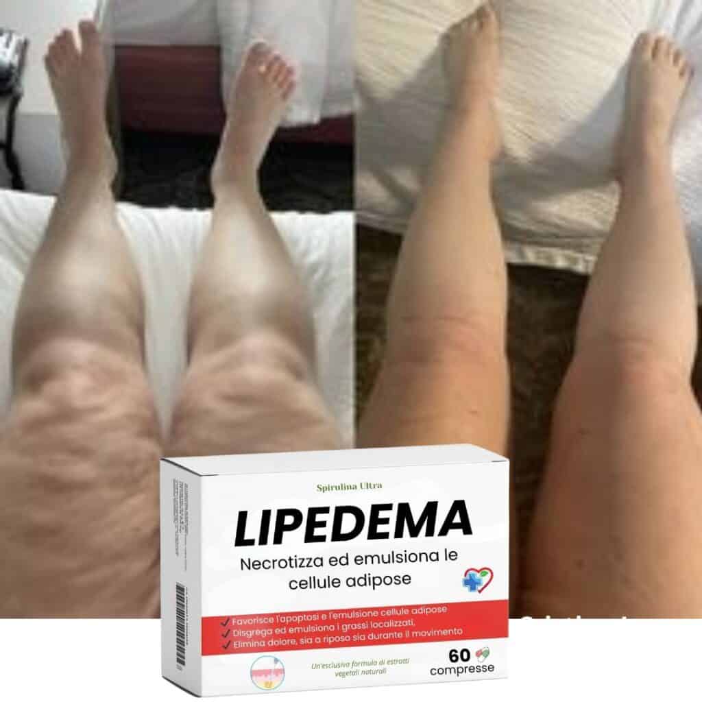 Variazione visibile delle gambe prima e dopo trattamento Lipedema, miglioramento della circolazione.
