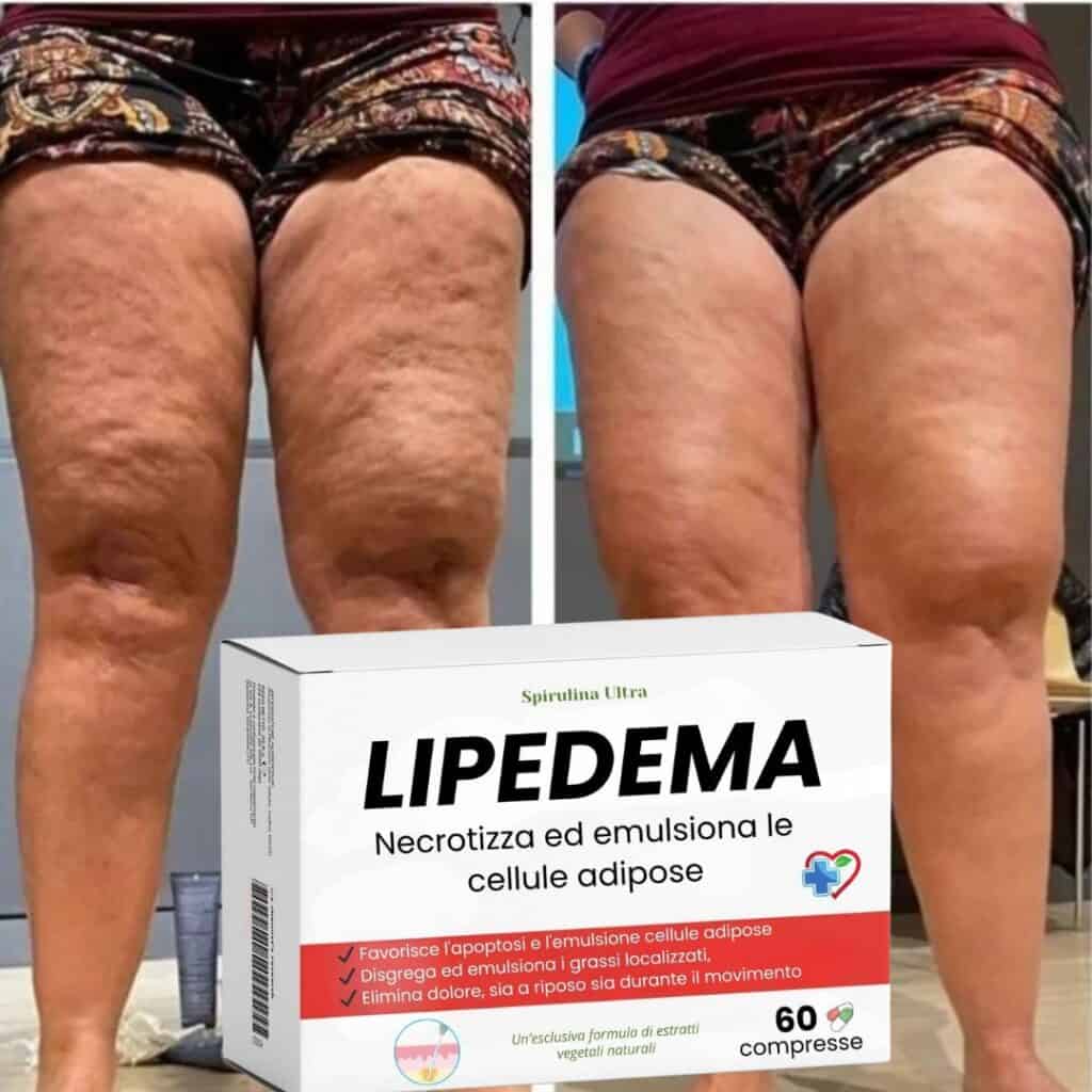 Trattamento naturale contro la lipedema e la cellulite alle cosce.
