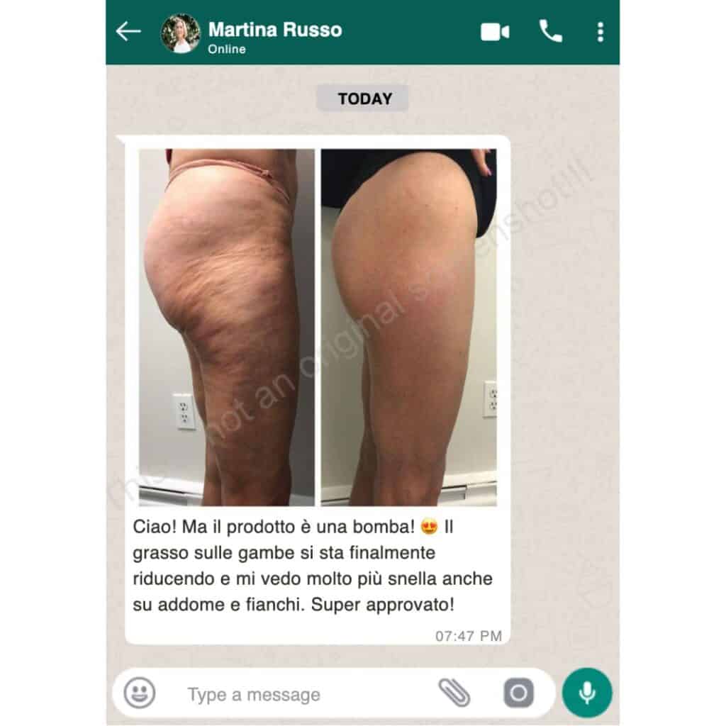 Prima e dopo trattamento per cellulite e smagliature sulle gambe, risultati visibili e miglioramenti.