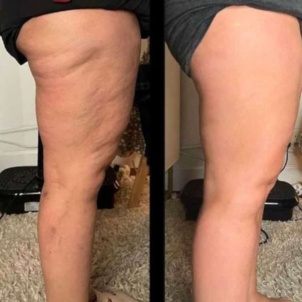 Prima e dopo trattamento cellulite sulle gambe.