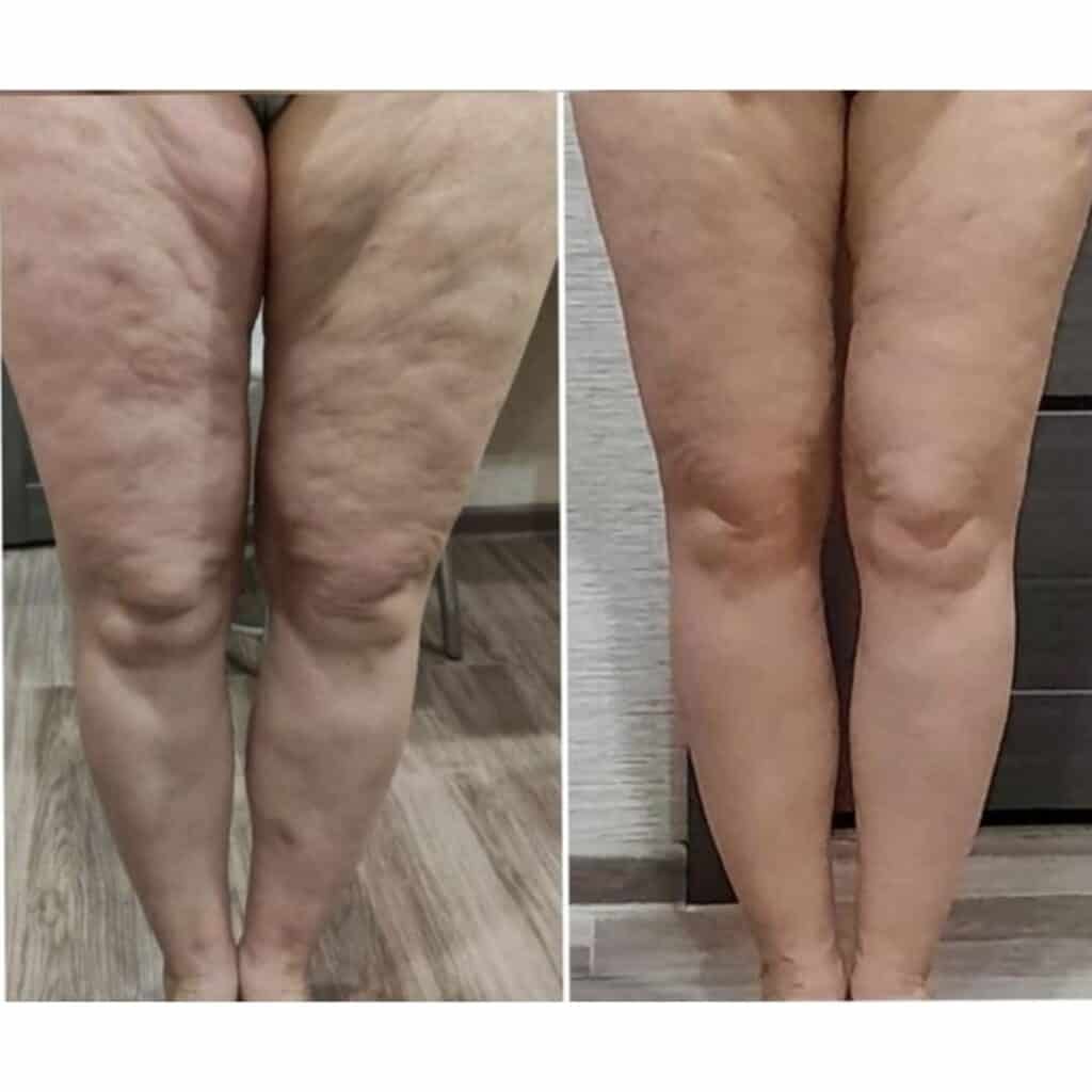 Prima e dopo trattamento vene varo sulle gambe.