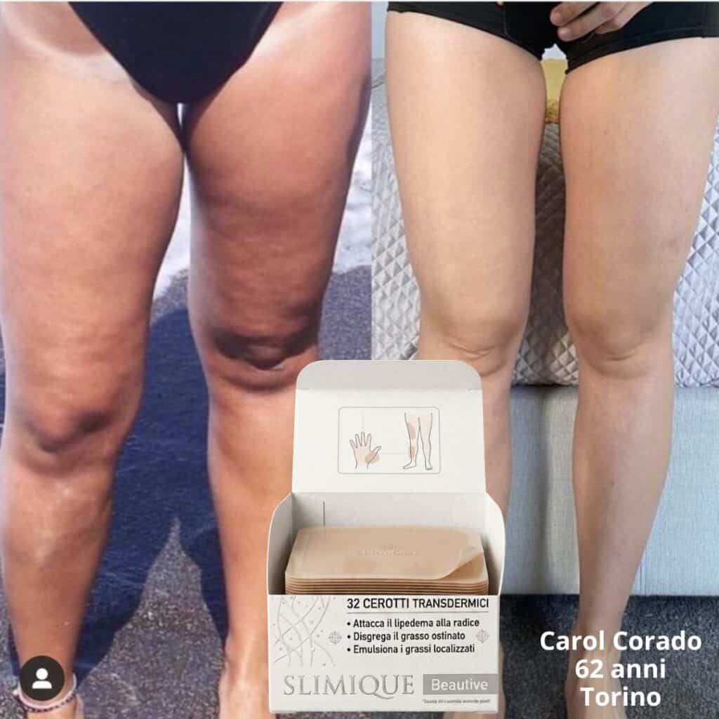 Doppia immagine di gambe prima e dopo trattamento con cerotti transdermici.